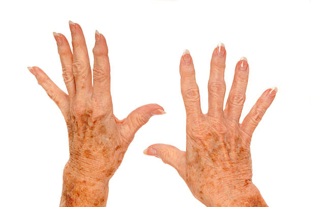 Elderly hands with visible signs of aging and skin conditions isolated on white background