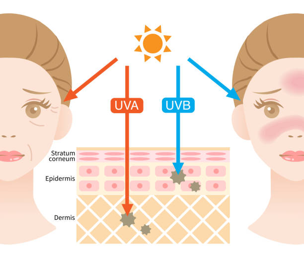 Diagram showing the effects of UVA and UVB rays on skin, illustrating sunburn and skin layers including the epider