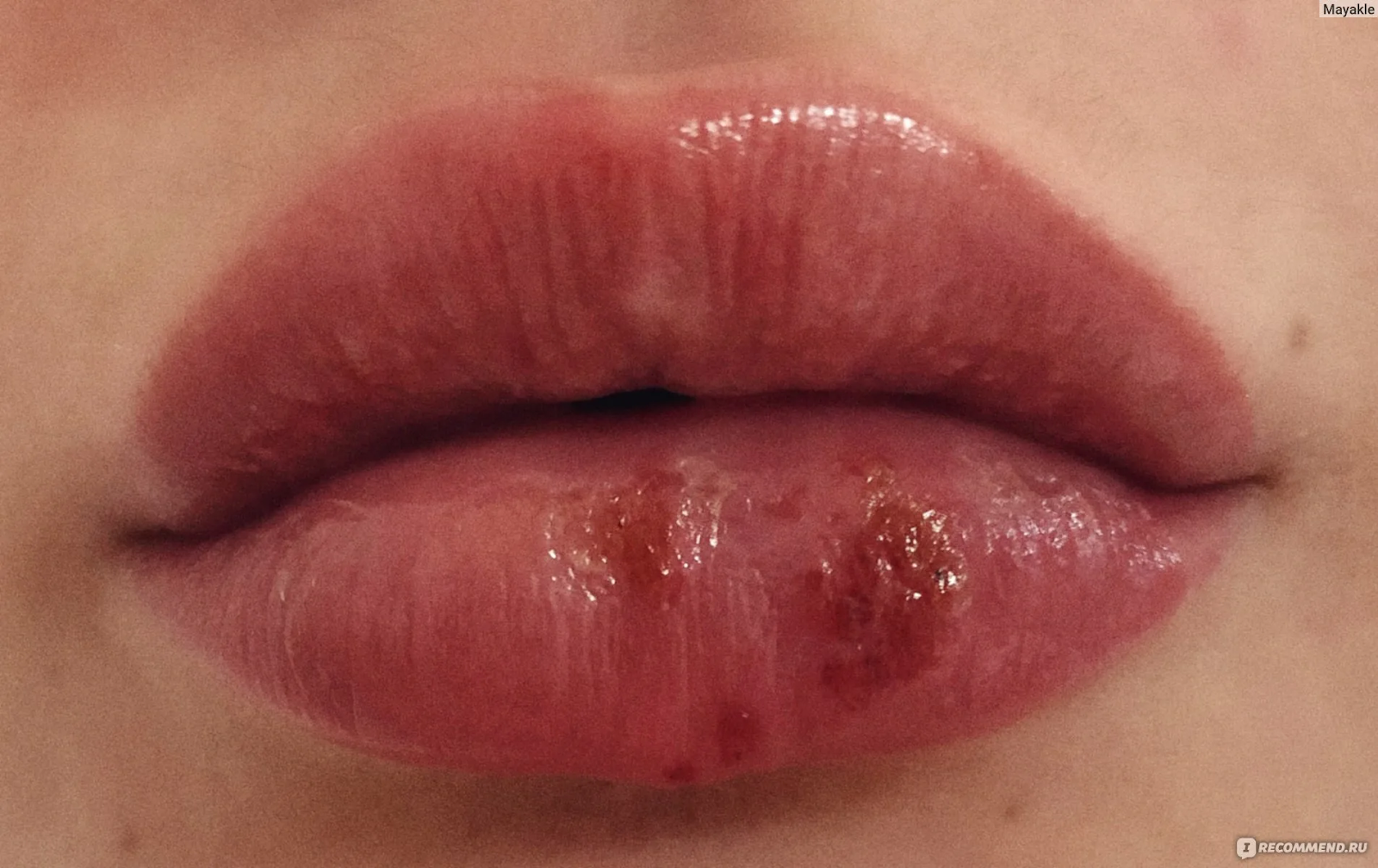 Mobreed | Cold Sore Management for Lip Tattoo Aftercare: Expert Tips and Advice